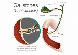 gallstones