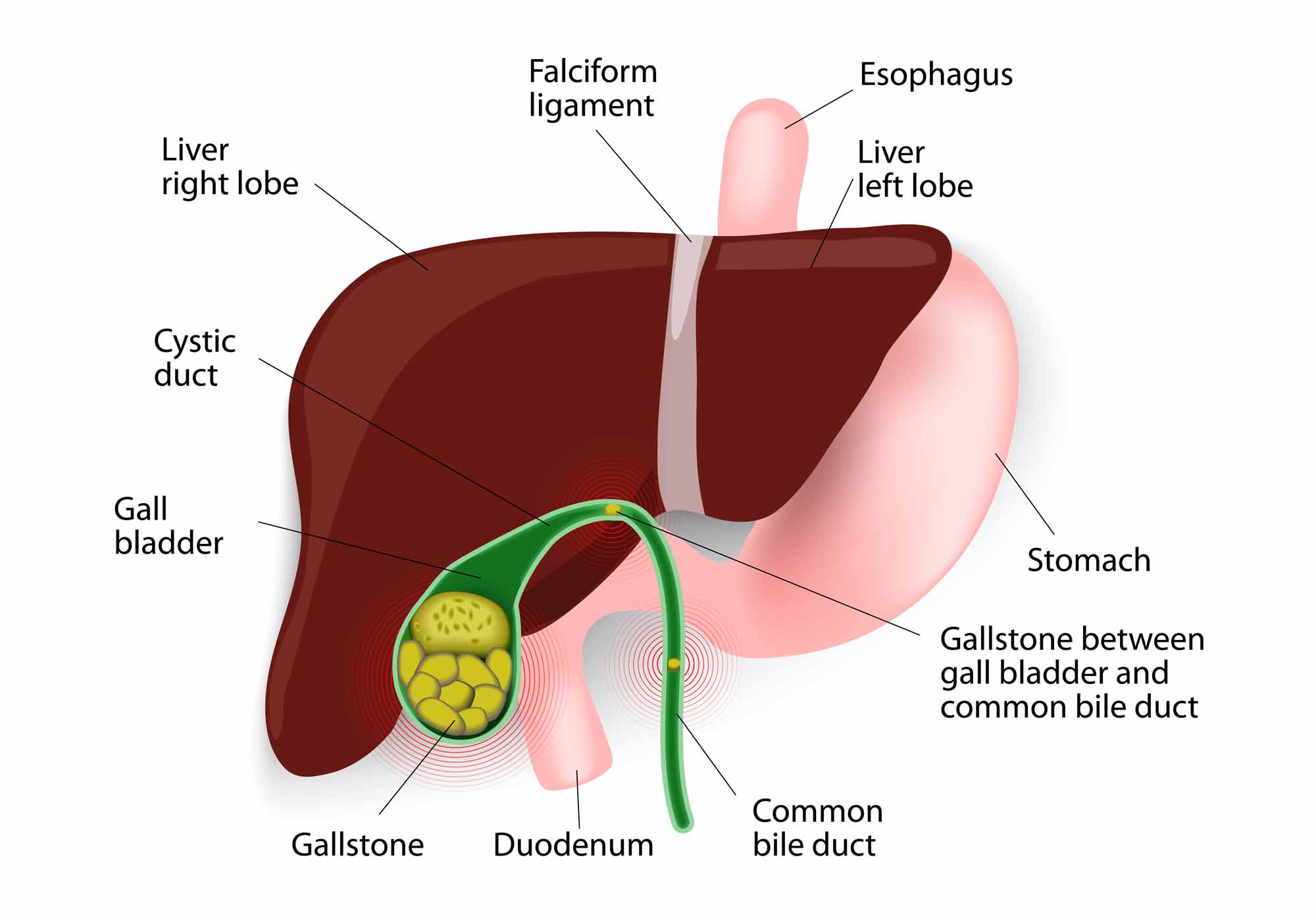 Gallstones Formation