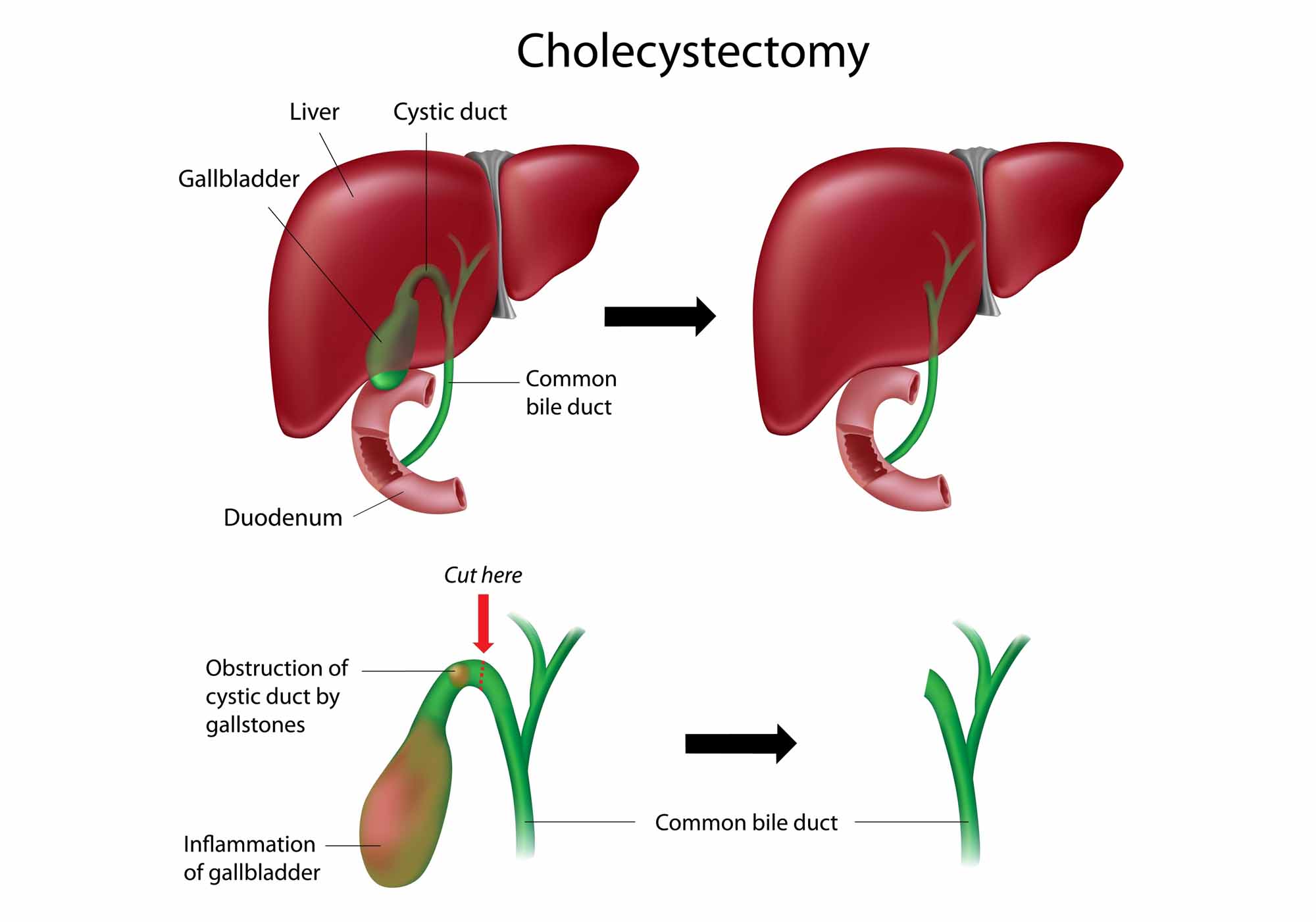 The gallbladder | Gallbladder Surgery