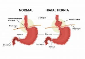 Hernia