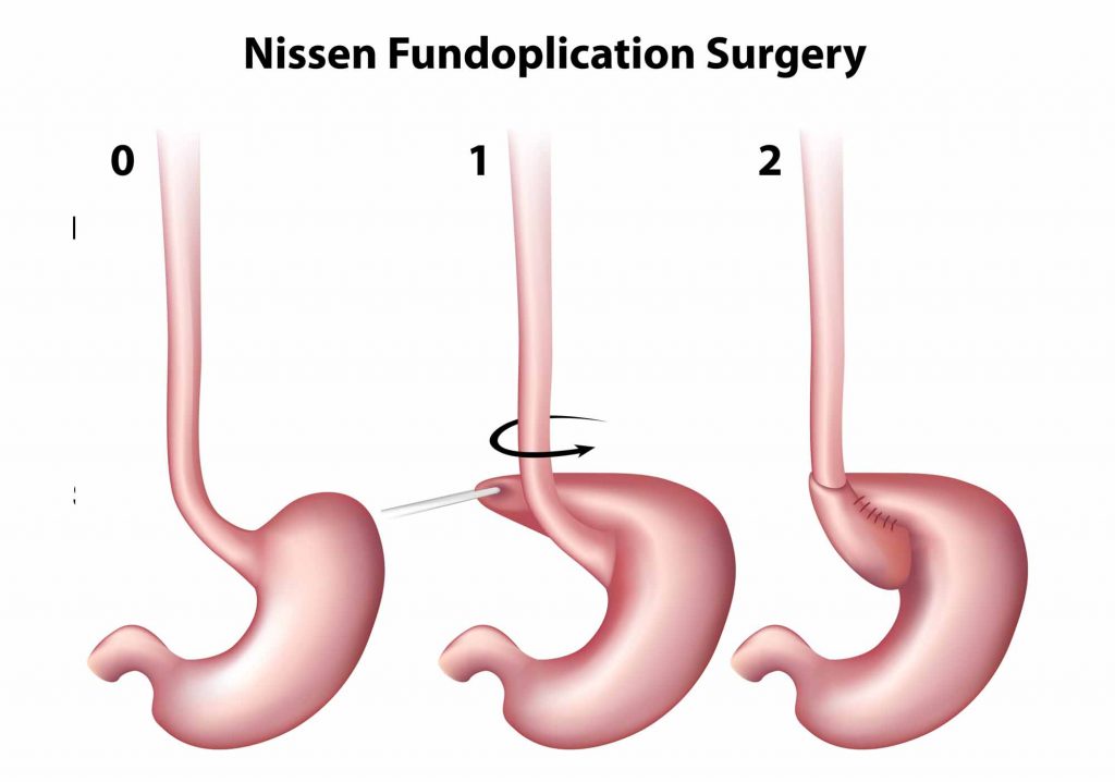 Hiatal Hernia Repair Dr Clay Albrecht hiatal-hernia-repair-dr-clay-albrecht