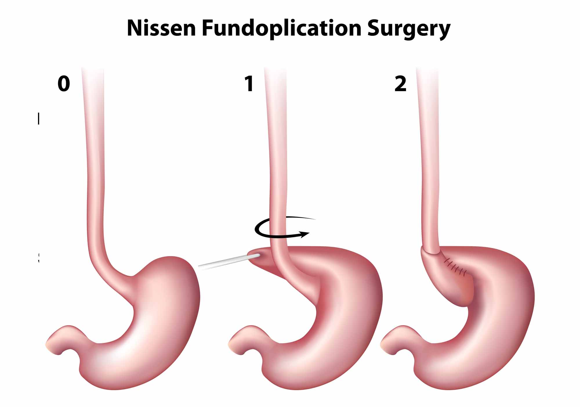 hiatal hernia repair surgery