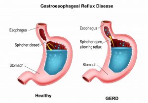 Hiatal Hernia