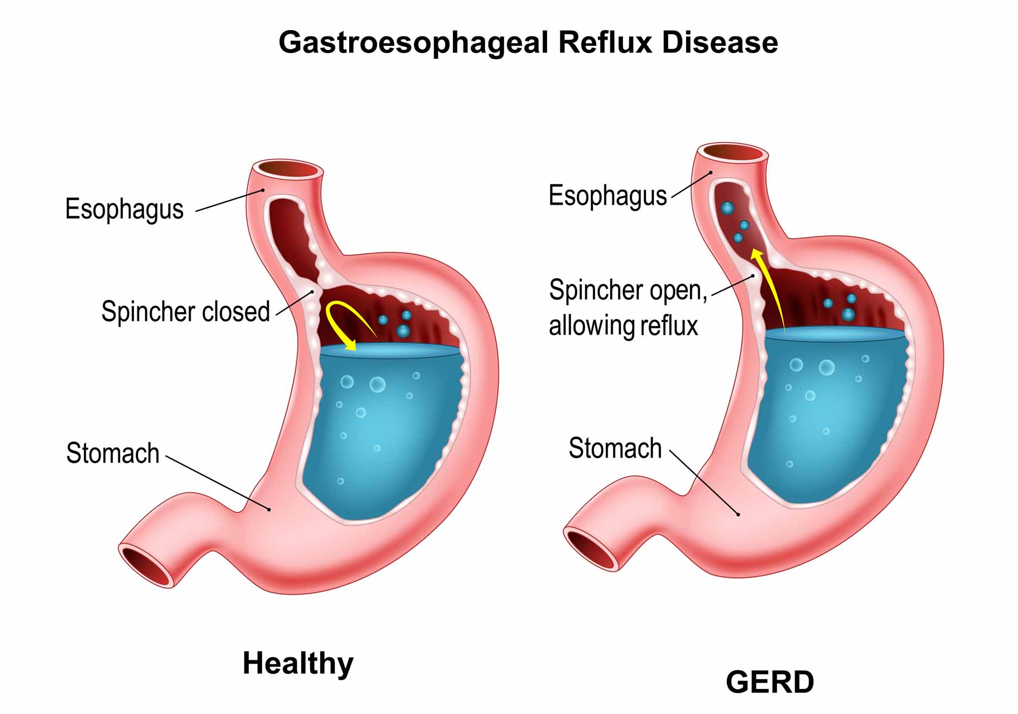 Hiatal Hernia Surgery In Katy TX Dr Clay Albrecht