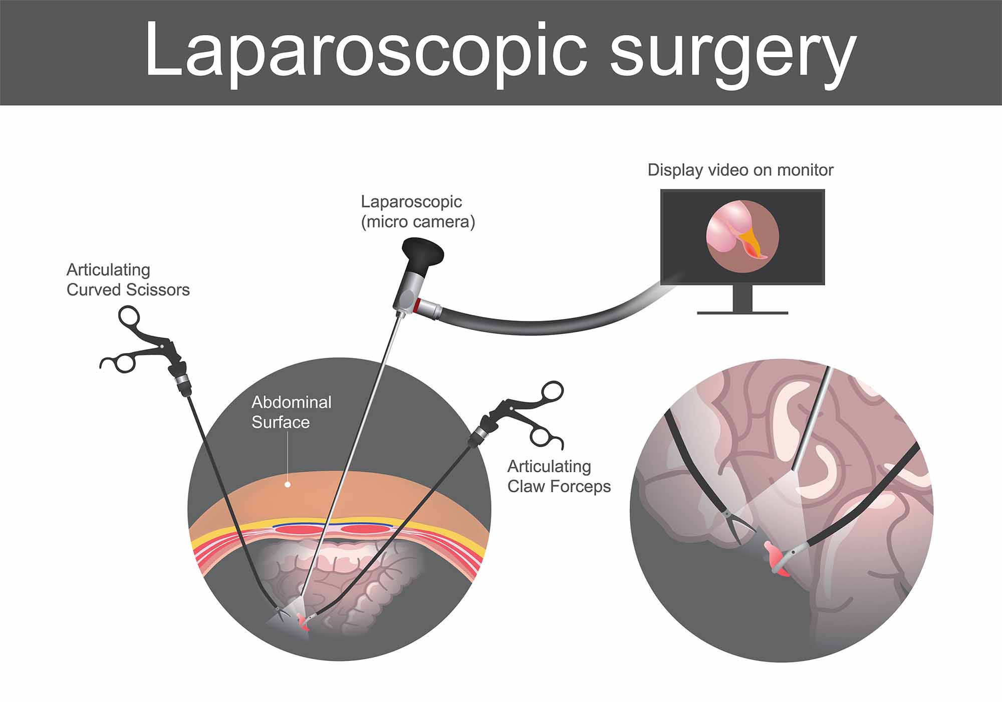laparoscopic hernia surgery